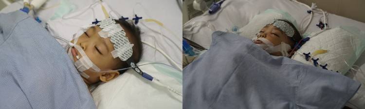 Pasca Operasi Pemisahan Bayi Kembar Siam Asal Labuhan Batu