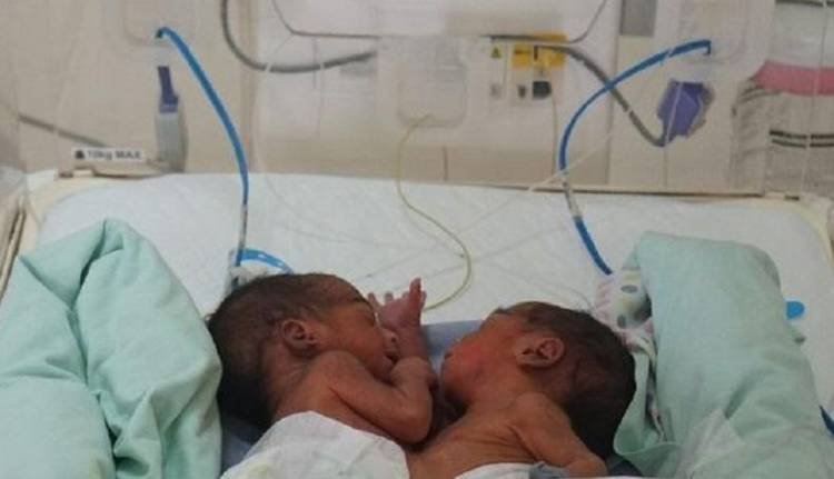 Bayi Kembar Siam dari Asahan Dirujuk ke RS Adam Malik