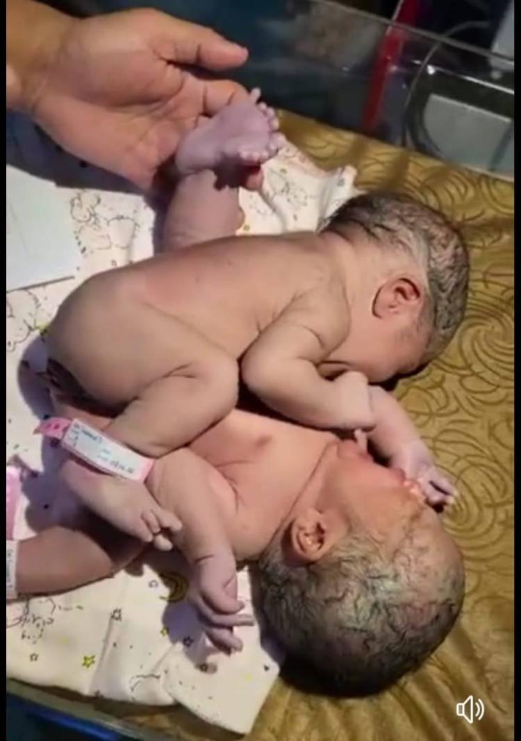 Bayi Kembar Siam Berkaki Tiga Lahir di Asahan