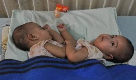 Bayi Kembar Siam Asal Batubara Dirawat di RS Adam Malik Butuh Donor ASI