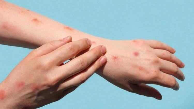 Kemenkes Ungkap Penularan 15 Kasus Cacar Monyet di RI dari Transmisi Lokal