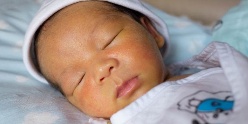 Penyebab Bayi Lahir Kuning: Apa Itu Kista Duktus Koledokus ?